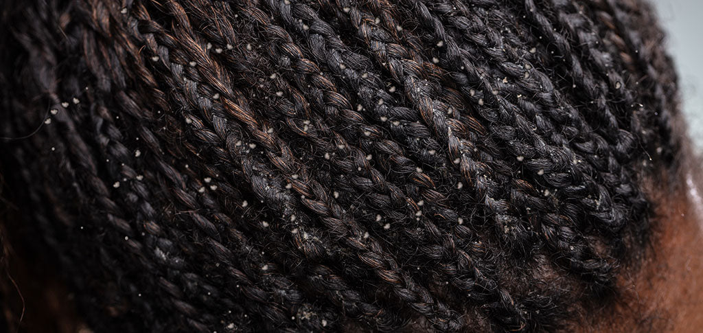 Image of Close-up Photo Of Dandruff In Woman's Hair